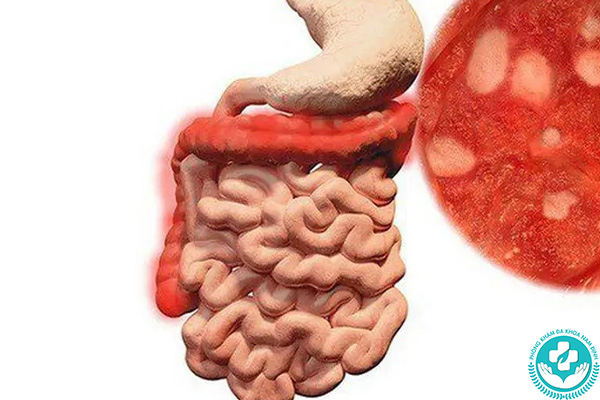 Nguyên nhân gây viêm hậu môn