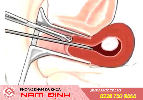 phá thai theo tuần