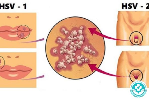 Nguyên nhân gây ra mụn rộp sinh dục