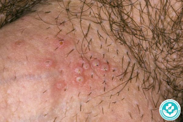 Biểu hiện thường thấy của mụn rộp sinh dục