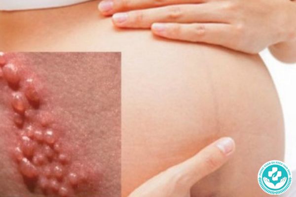 Nên làm gì khi đang mang thai mà phát hiện mắc bệnh mụn rộp sinh dục?