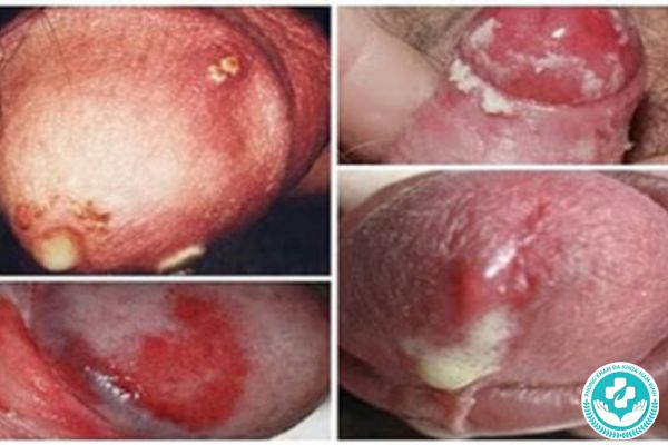 Nhóm bệnh xẫ hội mà nam giới thường gặp