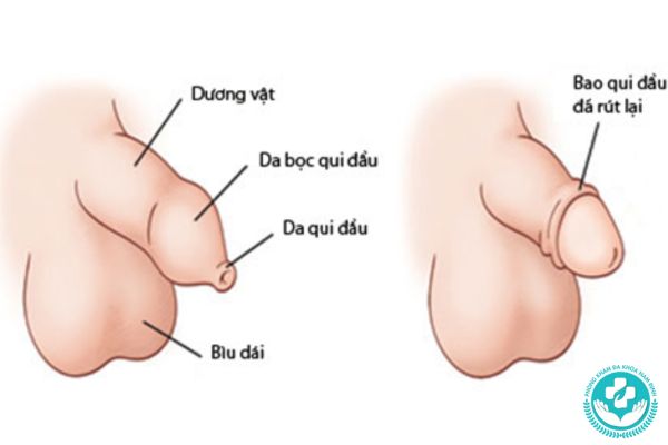 Nhóm bệnh bao quy đầu mà nam giới thường gặp