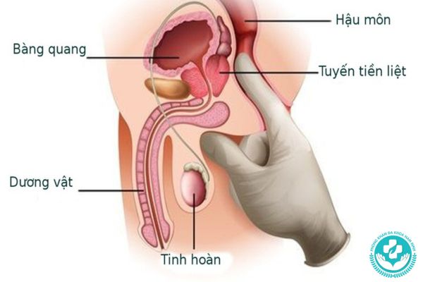 Nhóm bệnh tuyến tiền liệt mà nam giới thường gặp