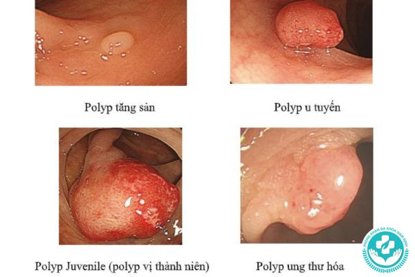 Có bao nhiêu loại polyp hậu môn?