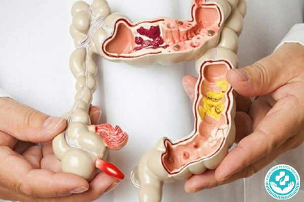 Cấu trúc hậu môn không bình thường có thể gây polyp hậu môn