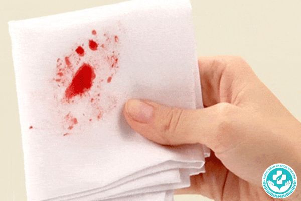 Nhận biết polyp hậu môn qua máu đỏ tươi dính trên giấy vệ sinh khi đi tiêu
