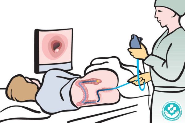 Cách để hỗ trợ điều trị polyp hậu môn