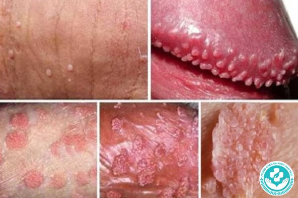 Dấu hiệu nhận biết sùi mào gà ở cả nam và nữ