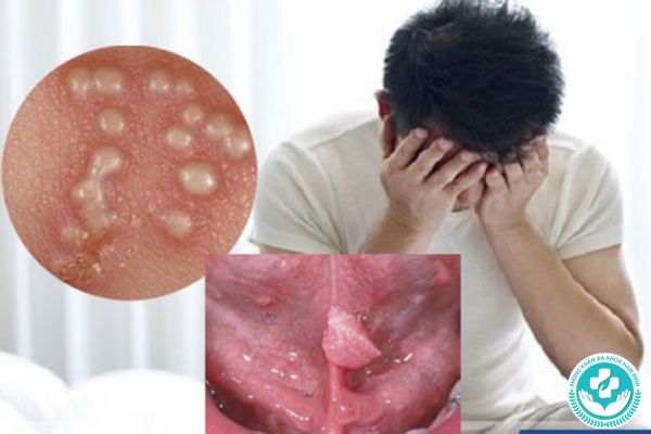 Sùi mào gà có nguy hiểm gì không?