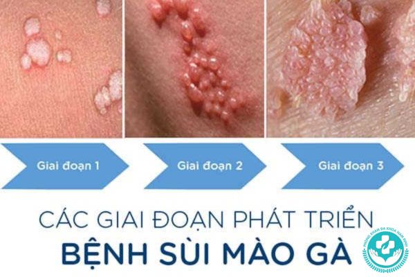Những giai đoạn phát triển của sùi mào gà