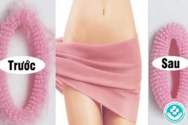 Lợi ích của thẩm mỹ vùng kín