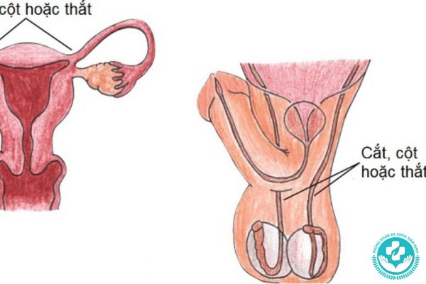Tránh thai bằng cách triệt sản hiệu quả (cả nam và nữ)