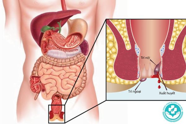 Biểu hiện thường thấy của trĩ hỗn hợp