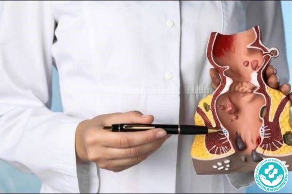 Phương pháp chữa bệnh trĩ hỗn hợp hiệu quả cao