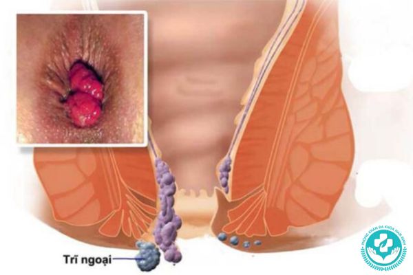Mức độ nguy hiểm của trĩ ngoại