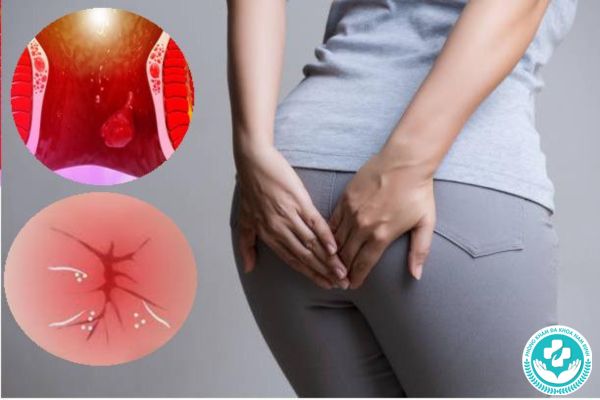 Ngứa xung quanh khu vực hậu môn hoặc trực tràng là biểu hiện của bệnh trĩ ngoại