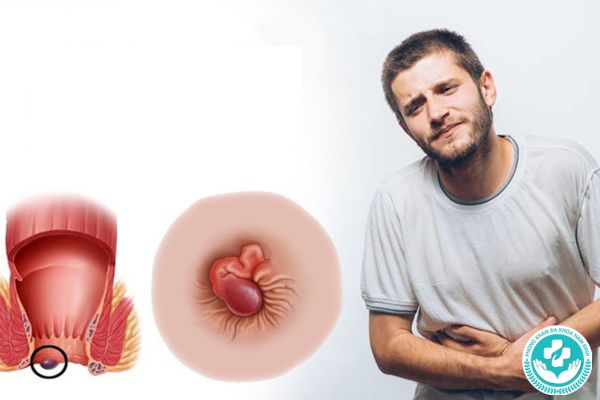 Trĩ ngoại có nguy hiểm gì không?