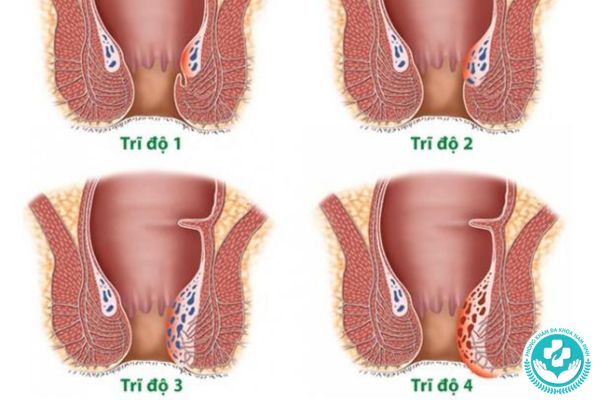 Có bao nhiêu loại trĩ nội?
