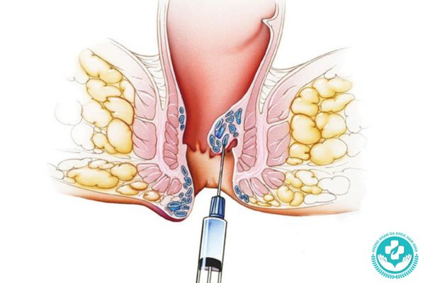 Cách chữa trĩ nội