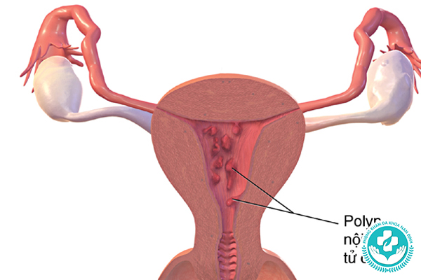 Xuất huyết tử cung bất thường (chảy máu âm đạo)