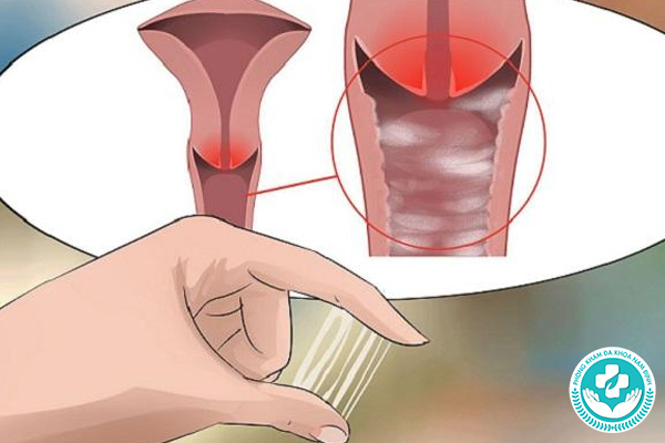 Viêm phụ khoa là gì?